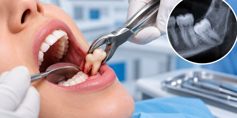 wisdom-tooth